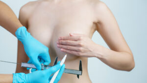 Chirurgie du mamelon